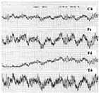 MRET EEG Test 3