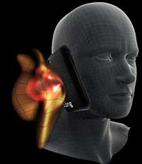 PONG moves radiation away from the head